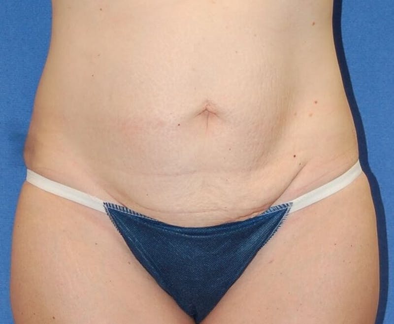 Tummy Tuck Before & After Gallery - Patient 89987959 - Image 1