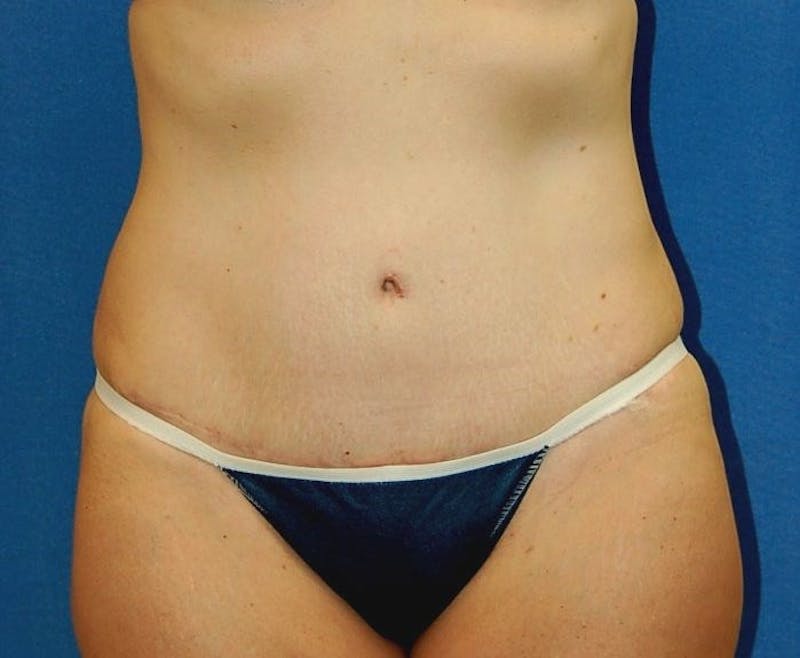 Tummy Tuck Before & After Gallery - Patient 89987959 - Image 2
