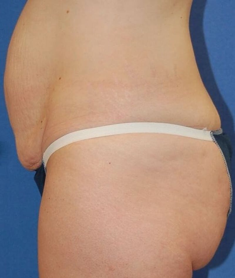 Tummy Tuck Before & After Gallery - Patient 89987959 - Image 3