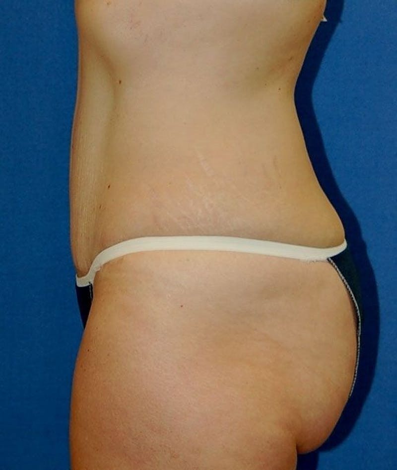 Tummy Tuck Before & After Gallery - Patient 89987959 - Image 4