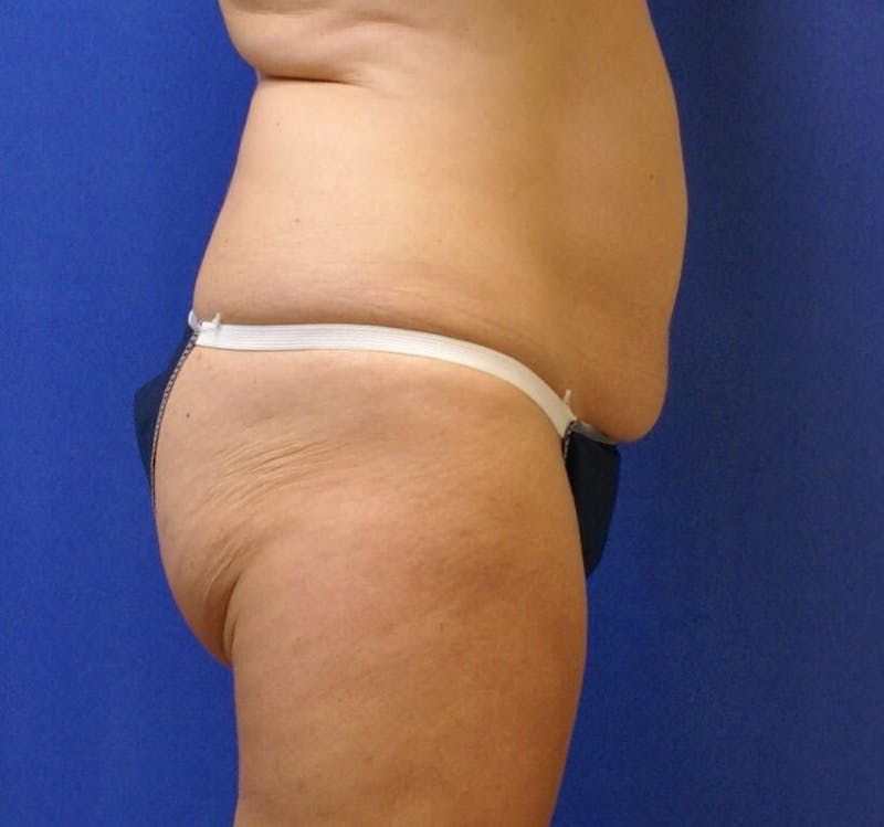 Tummy Tuck Before & After Gallery - Patient 89987960 - Image 1