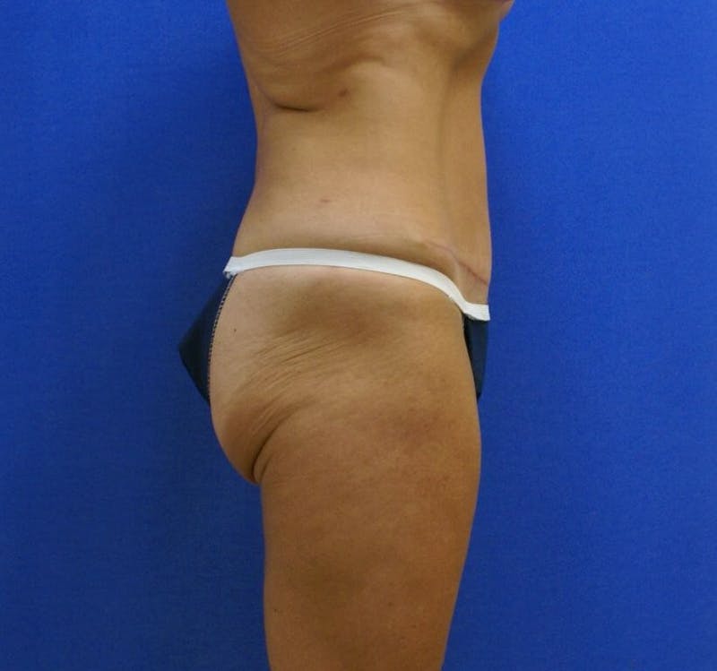 Tummy Tuck Before & After Gallery - Patient 89987960 - Image 2