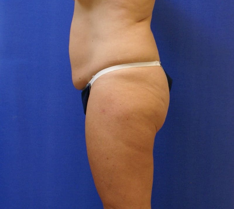 Tummy Tuck Before & After Gallery - Patient 89987960 - Image 3