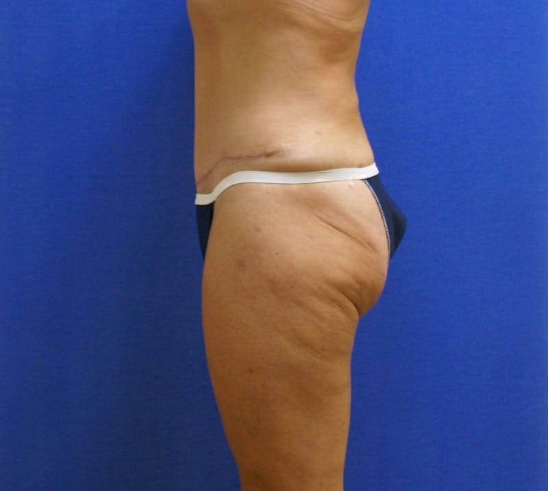Tummy Tuck Before & After Gallery - Patient 89987960 - Image 4