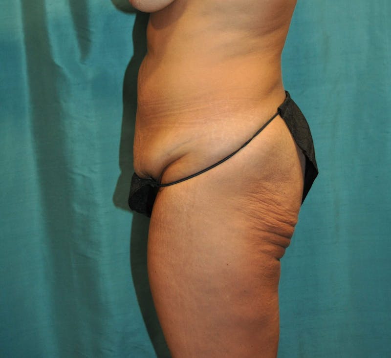 Tummy Tuck Before & After Gallery - Patient 89987963 - Image 1