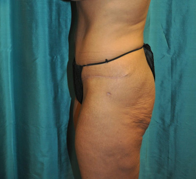Tummy Tuck Before & After Gallery - Patient 89987963 - Image 2