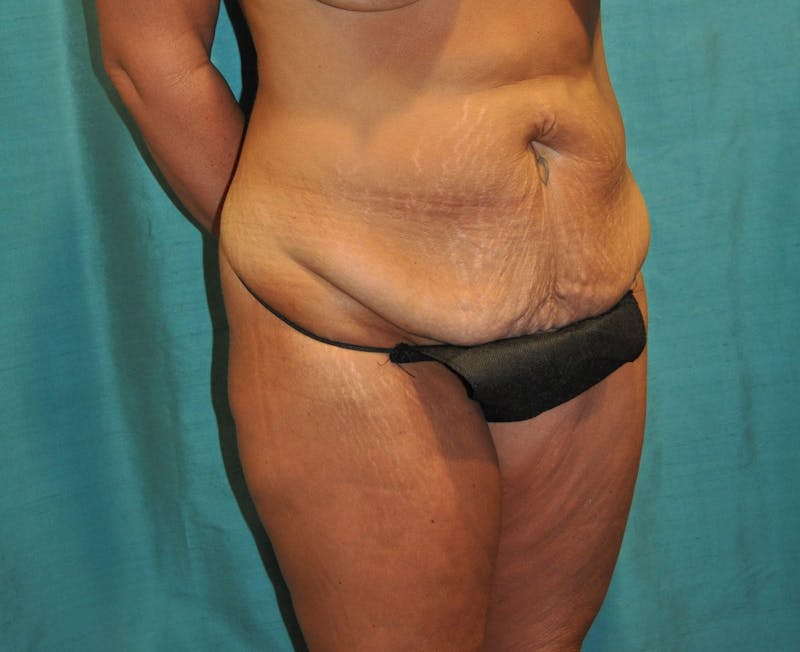 Tummy Tuck Before & After Gallery - Patient 89987963 - Image 3