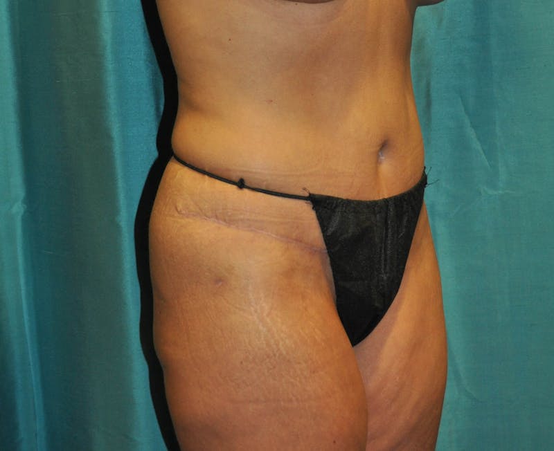 Tummy Tuck Before & After Gallery - Patient 89987963 - Image 4
