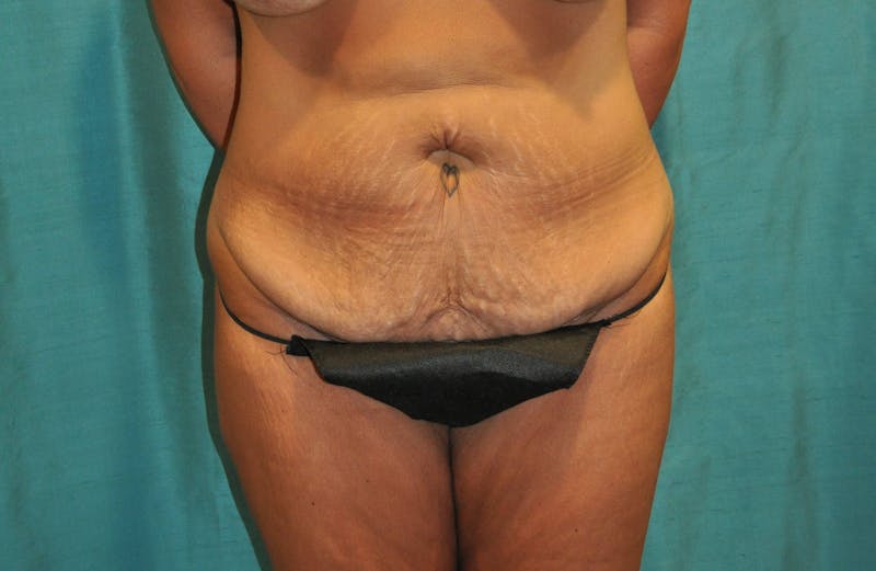 Tummy Tuck Before & After Gallery - Patient 89987963 - Image 5