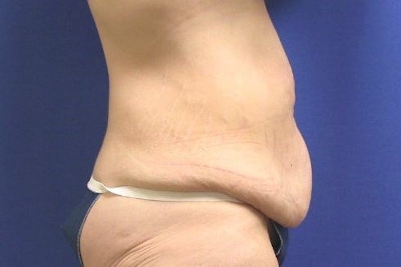 Tummy Tuck Before & After Gallery - Patient 89987976 - Image 1