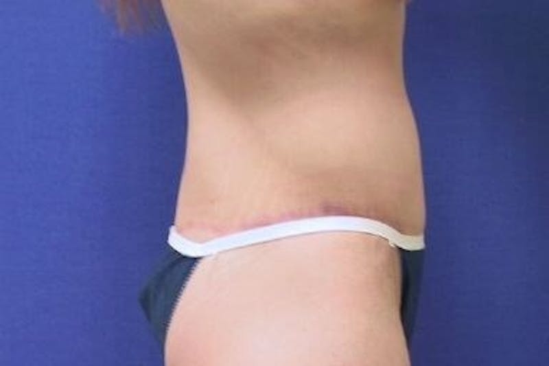 Tummy Tuck Before & After Gallery - Patient 89987976 - Image 2
