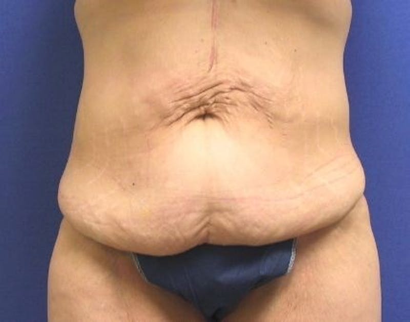 Tummy Tuck Before & After Gallery - Patient 89987976 - Image 3