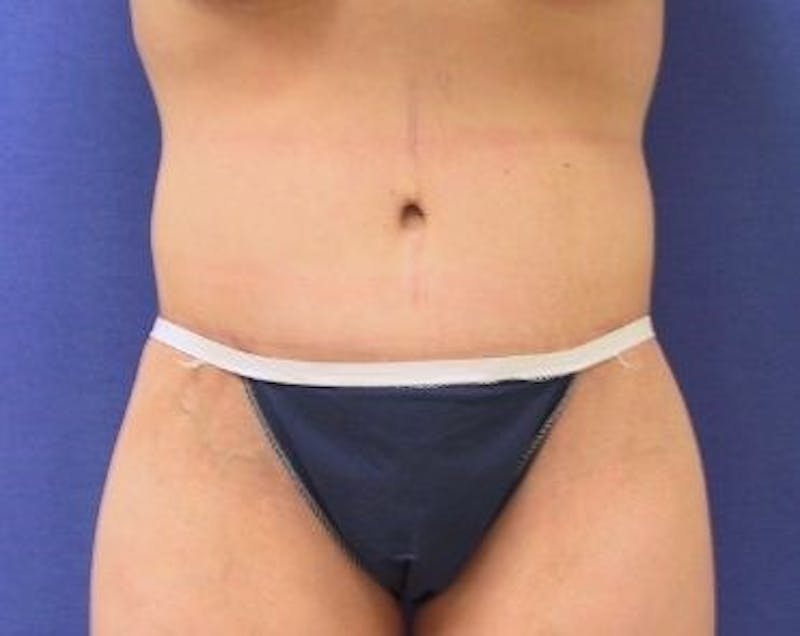 Tummy Tuck Before & After Gallery - Patient 89987976 - Image 4