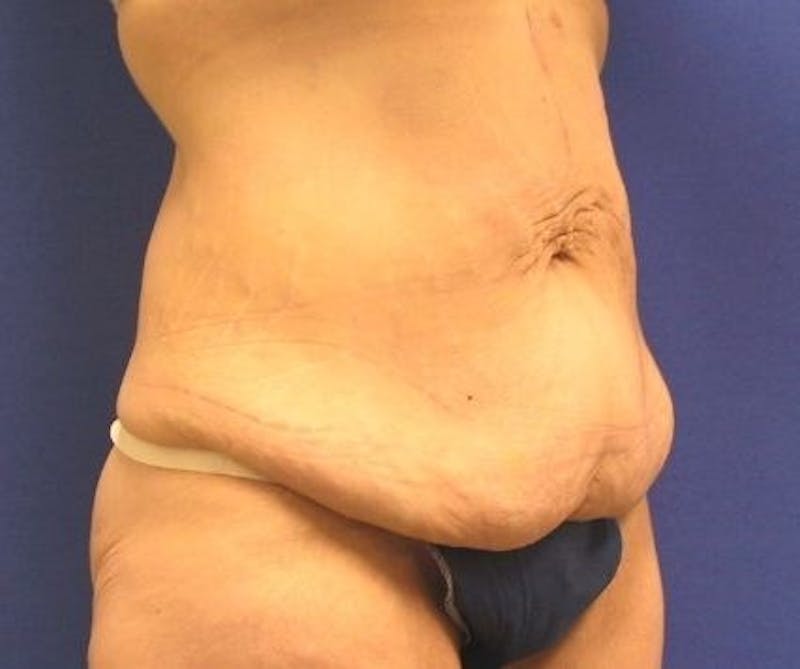 Tummy Tuck Before & After Gallery - Patient 89987976 - Image 5