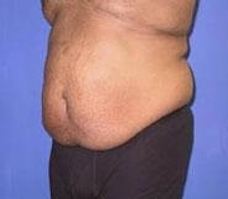 Tummy Tuck Before & After Gallery - Patient 89987978 - Image 1
