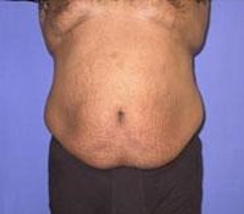 Tummy Tuck Before & After Gallery - Patient 89987978 - Image 3