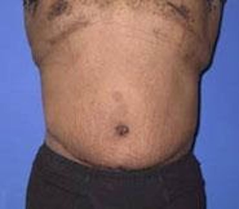 Tummy Tuck Before & After Gallery - Patient 89987978 - Image 4