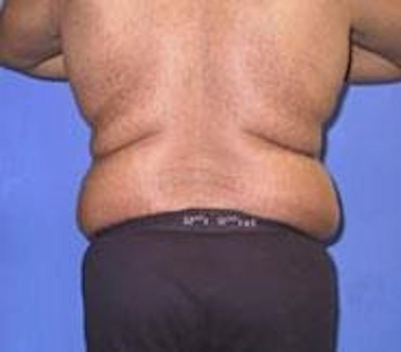 Tummy Tuck Before & After Gallery - Patient 89987978 - Image 5