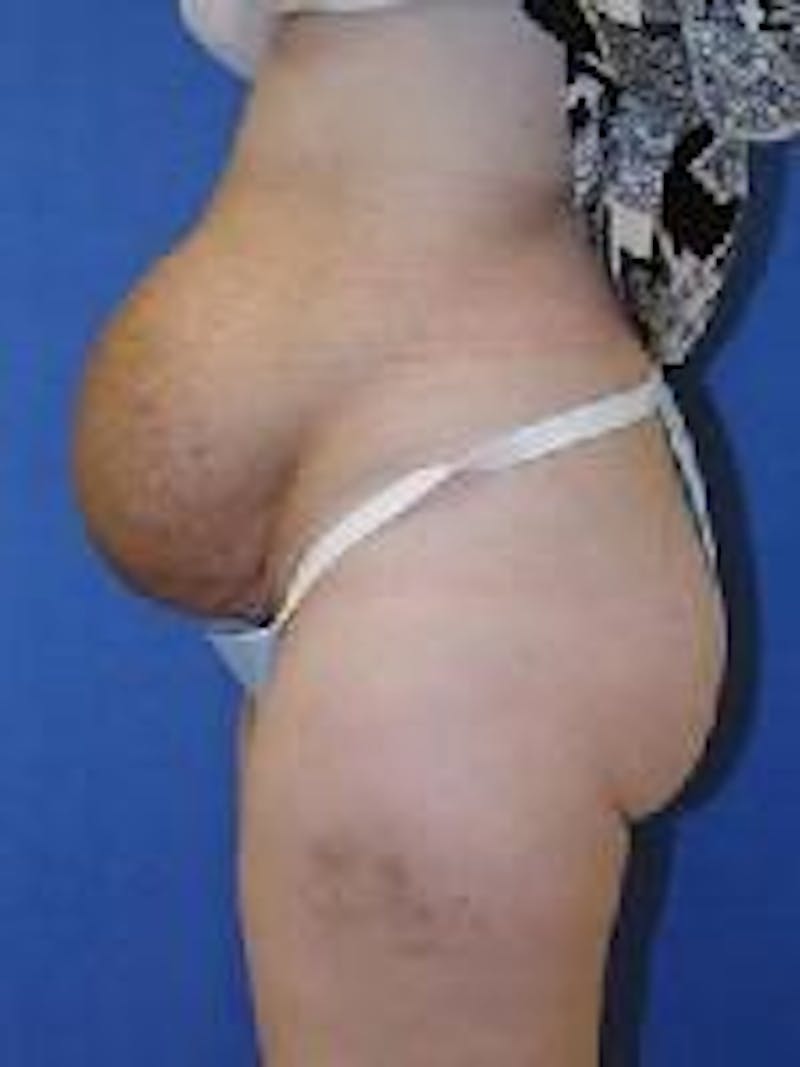 Tummy Tuck Before & After Gallery - Patient 89987985 - Image 1