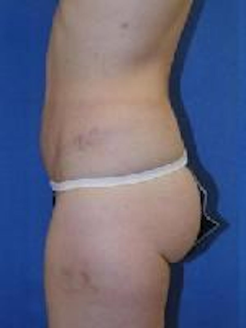 Tummy Tuck Before & After Gallery - Patient 89987985 - Image 2