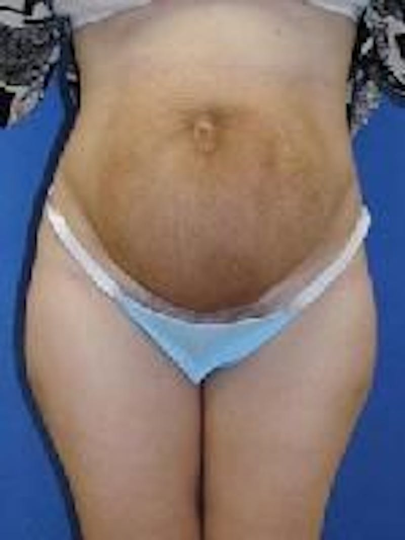 Tummy Tuck Before & After Gallery - Patient 89987985 - Image 3