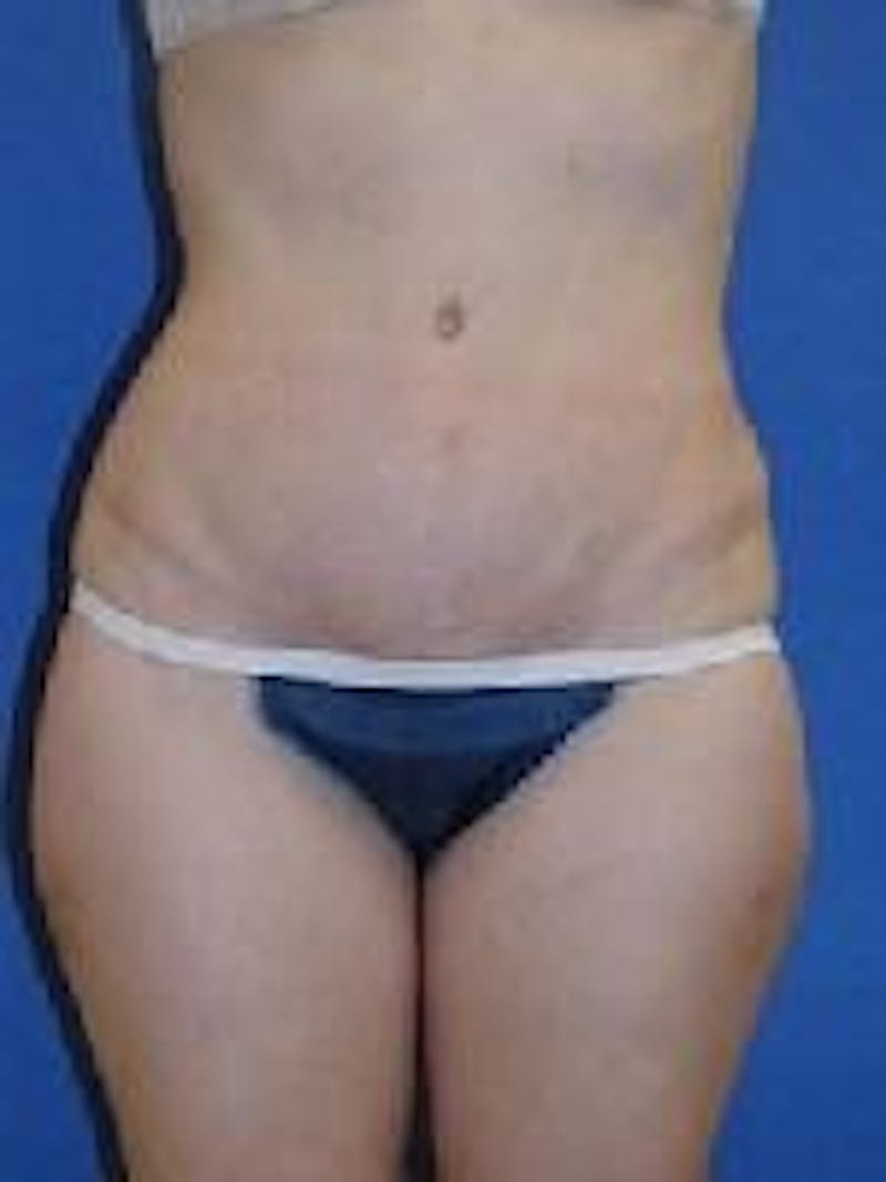 Tummy Tuck Before & After Gallery - Patient 89987985 - Image 4