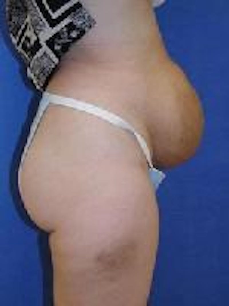 Tummy Tuck Before & After Gallery - Patient 89987985 - Image 5