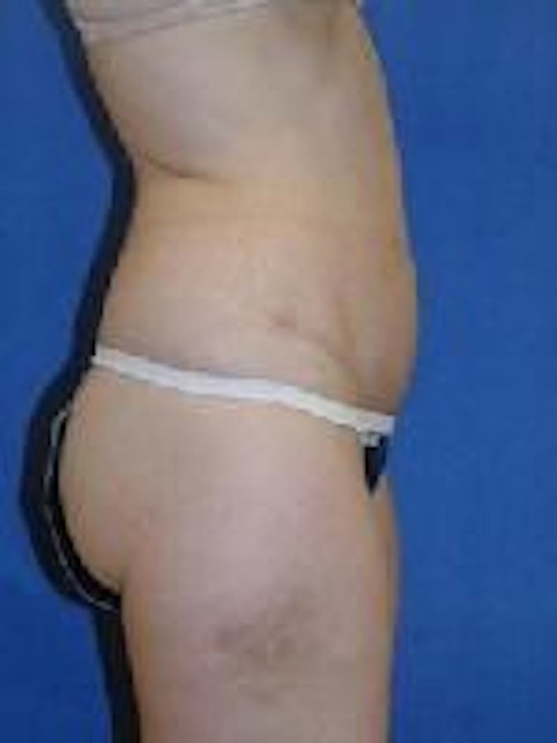 Tummy Tuck Before & After Gallery - Patient 89987985 - Image 6