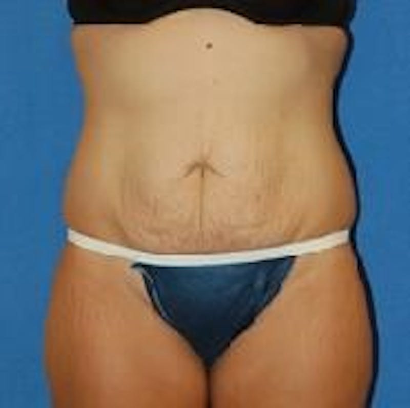 Tummy Tuck Before & After Gallery - Patient 89987986 - Image 1