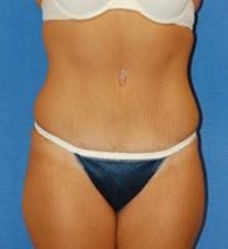 Tummy Tuck Before & After Gallery - Patient 89987986 - Image 2