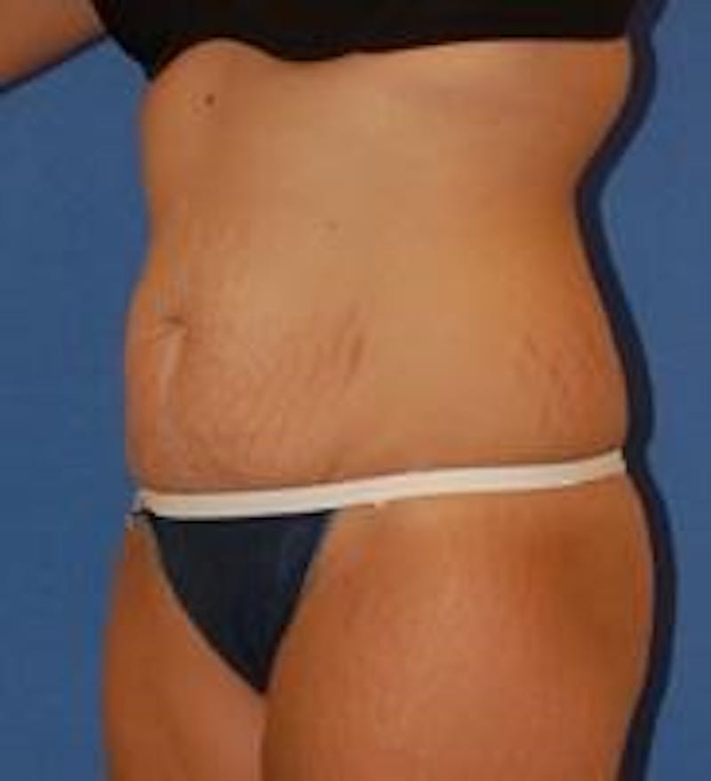 Tummy Tuck Before & After Gallery - Patient 89987986 - Image 3