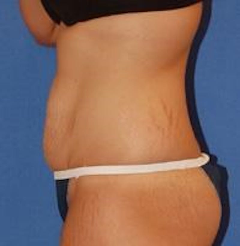 Tummy Tuck Before & After Gallery - Patient 89987986 - Image 5