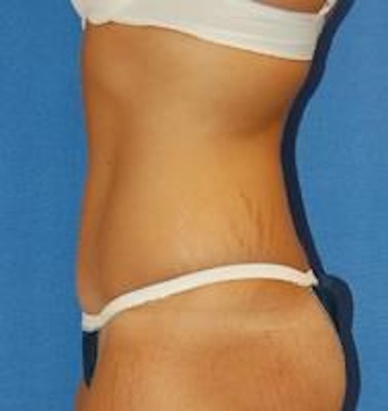 Tummy Tuck Before & After Gallery - Patient 89987986 - Image 6