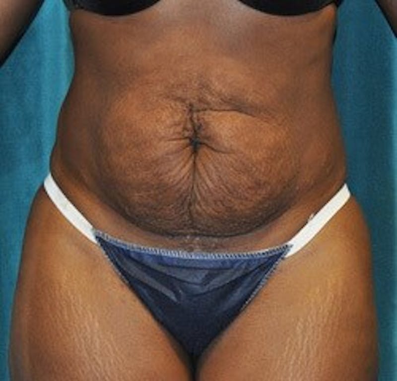 Tummy Tuck Before & After Gallery - Patient 89987987 - Image 1
