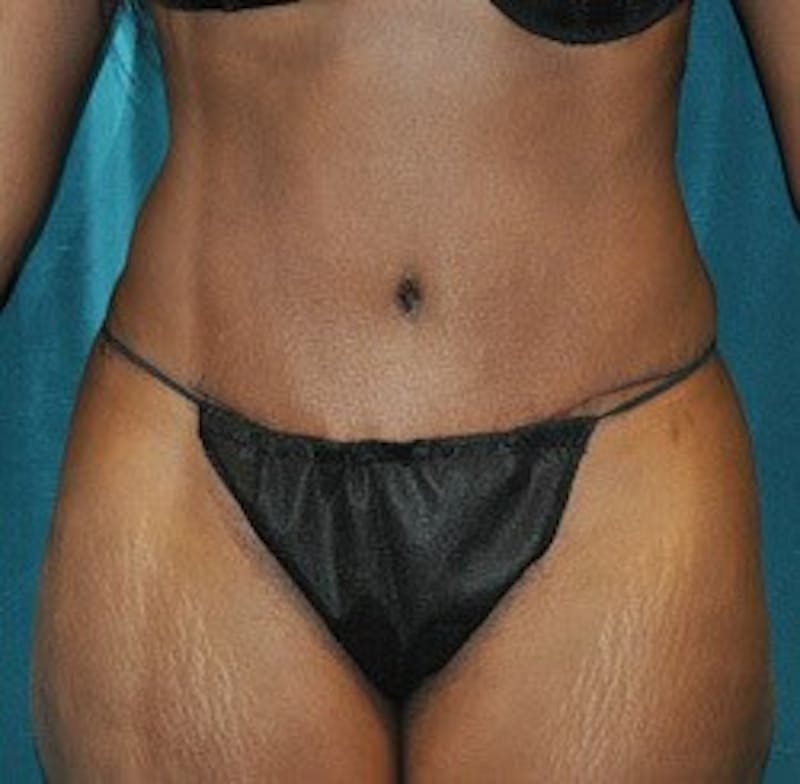 Tummy Tuck Before & After Gallery - Patient 89987987 - Image 2