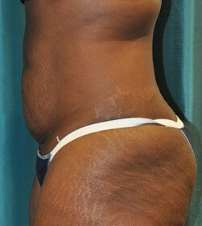 Tummy Tuck Before & After Gallery - Patient 89987987 - Image 3