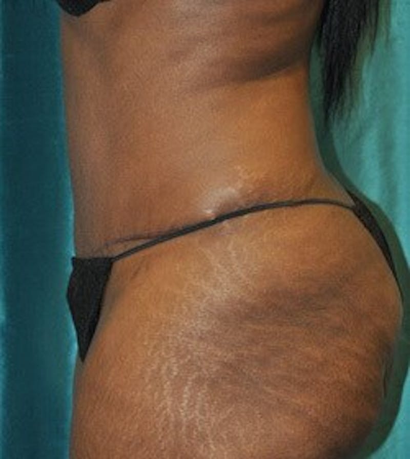 Tummy Tuck Before & After Gallery - Patient 89987987 - Image 4