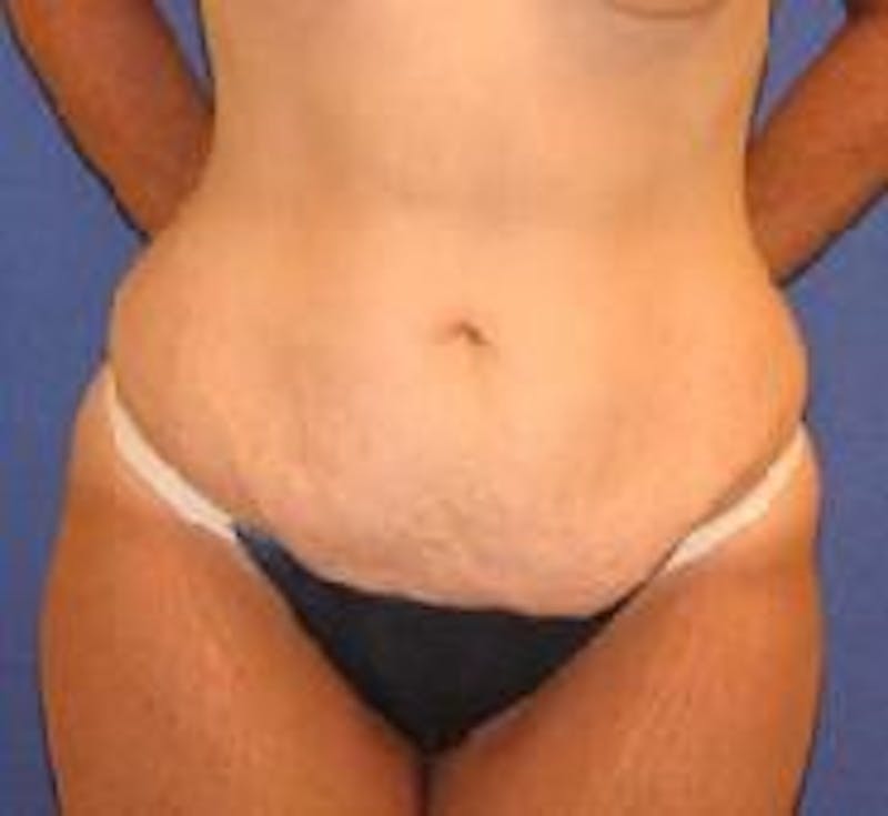 Tummy Tuck Before & After Gallery - Patient 89987990 - Image 1