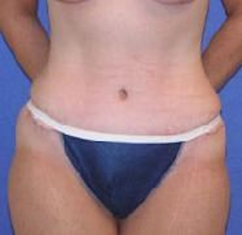 Tummy Tuck Before & After Gallery - Patient 89987990 - Image 2