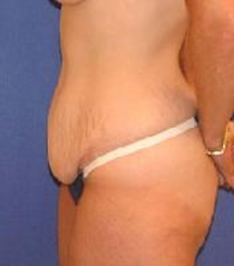 Tummy Tuck Before & After Gallery - Patient 89987990 - Image 3