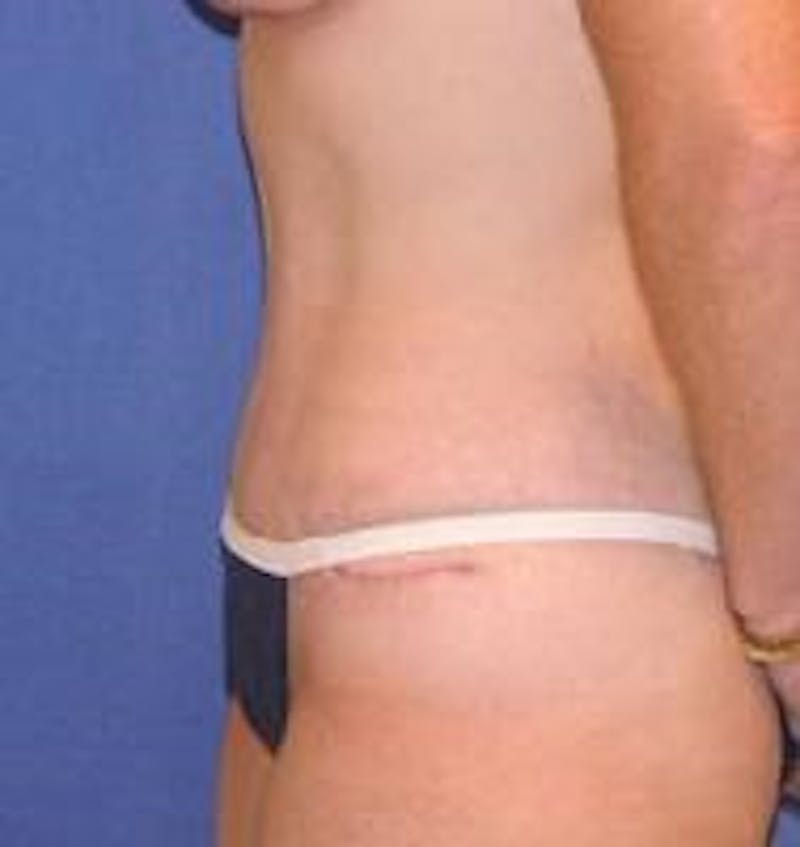 Tummy Tuck Before & After Gallery - Patient 89987990 - Image 4