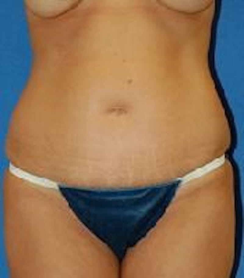 Tummy Tuck Before & After Gallery - Patient 89987991 - Image 1