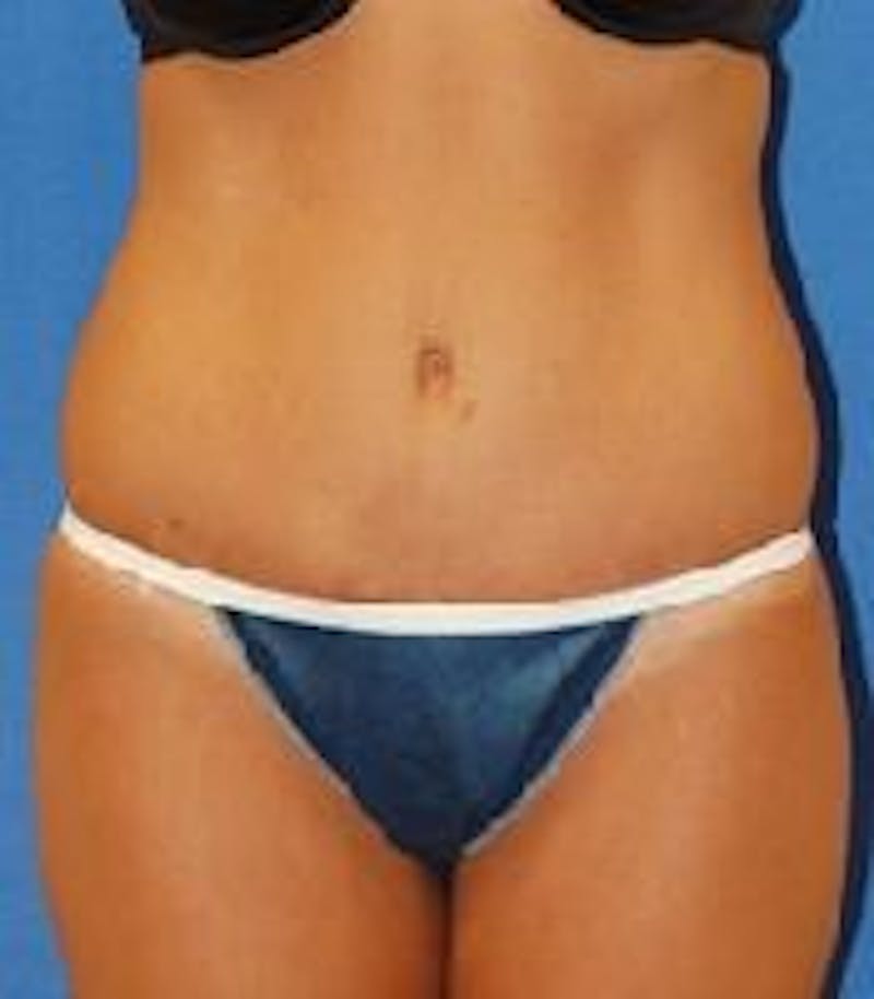 Tummy Tuck Before & After Gallery - Patient 89987991 - Image 2