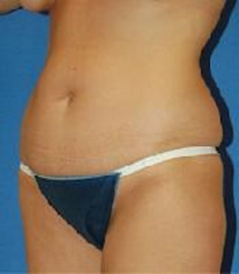 Tummy Tuck Before & After Gallery - Patient 89987991 - Image 3