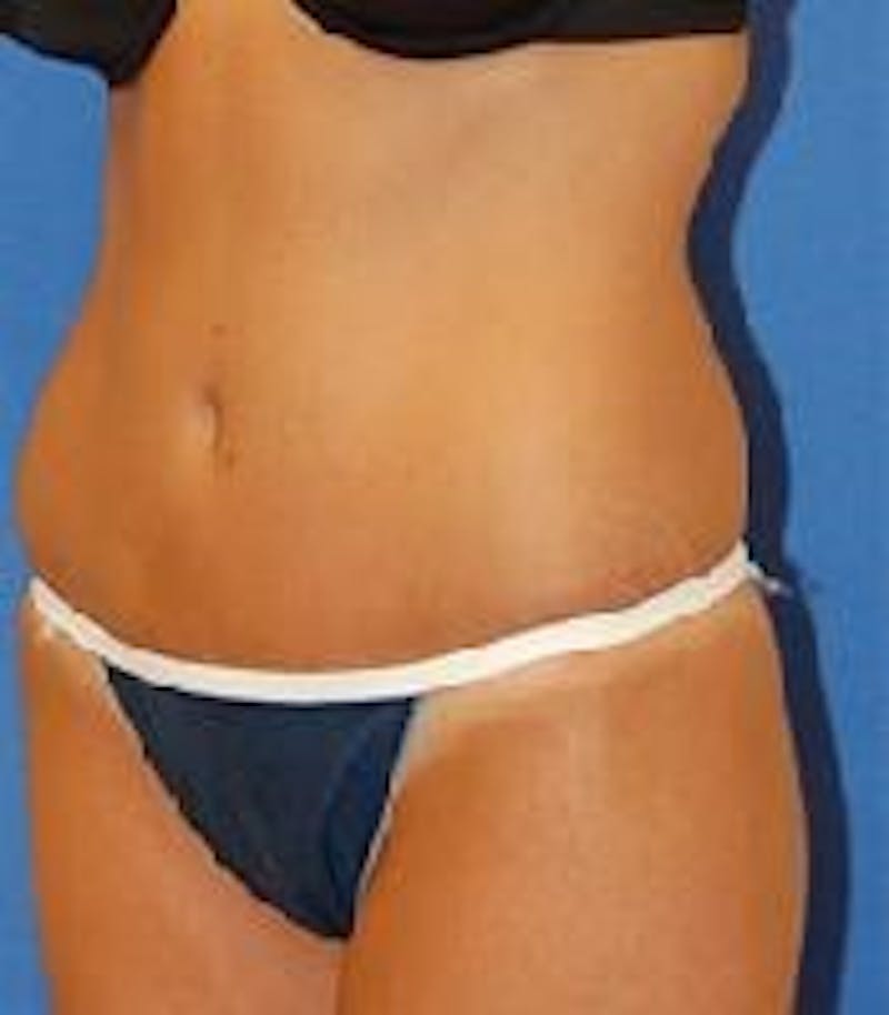 Tummy Tuck Before & After Gallery - Patient 89987991 - Image 4