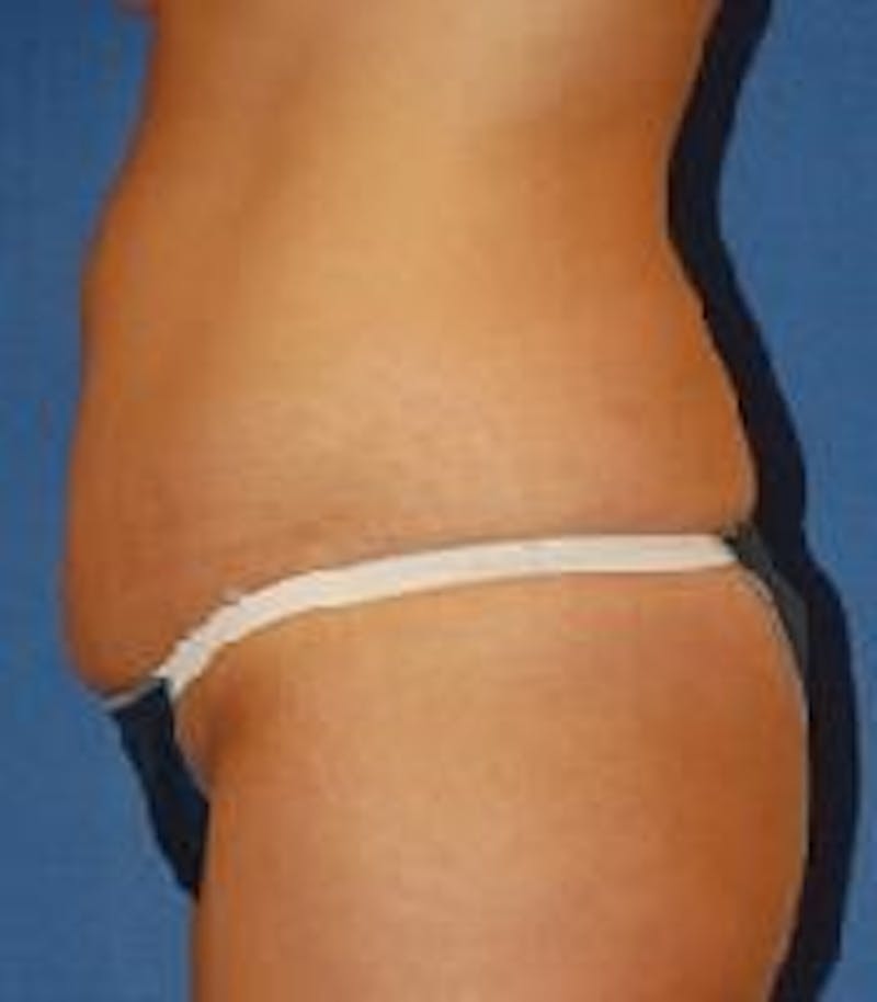 Tummy Tuck Before & After Gallery - Patient 89987991 - Image 5