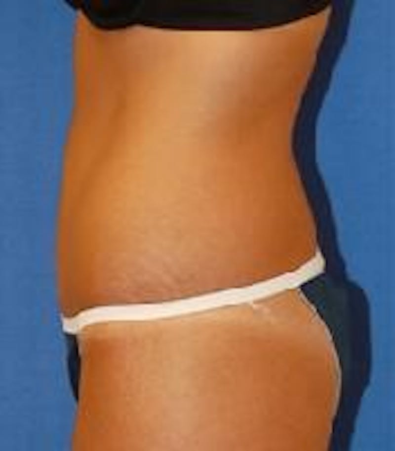 Tummy Tuck Before & After Gallery - Patient 89987991 - Image 6