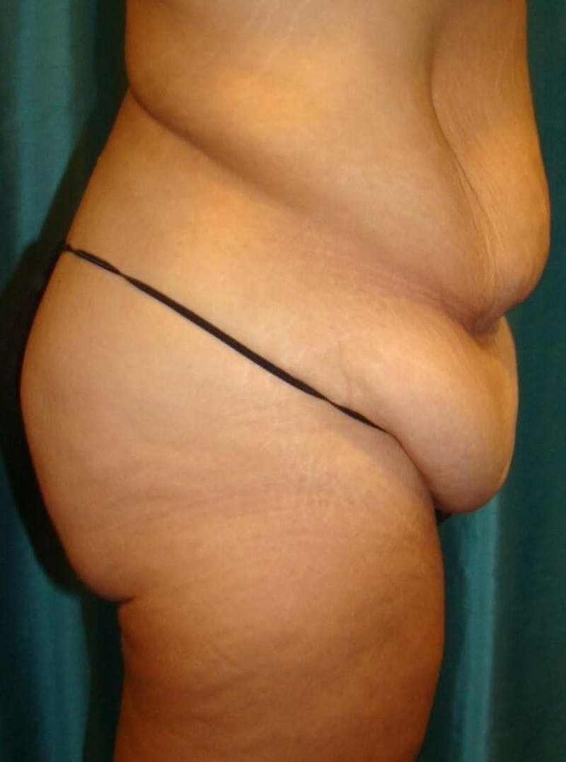 Tummy Tuck Before & After Gallery - Patient 89987992 - Image 1