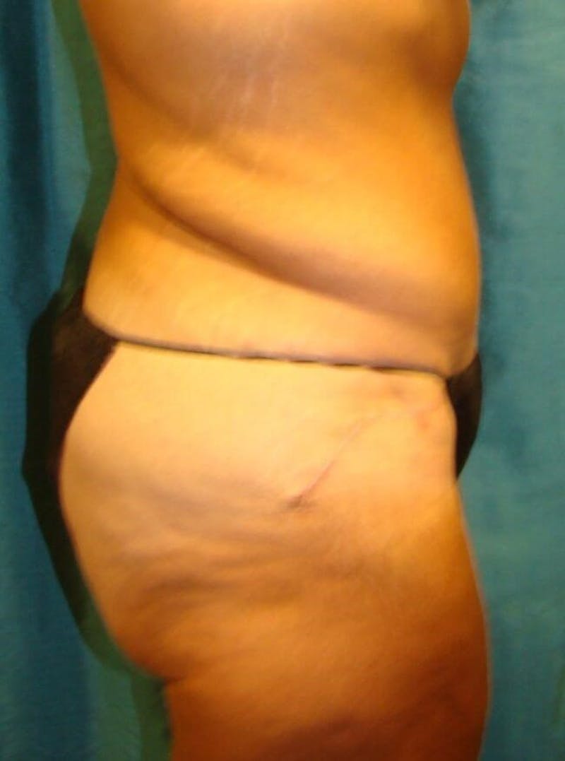 Tummy Tuck Before & After Gallery - Patient 89987992 - Image 2