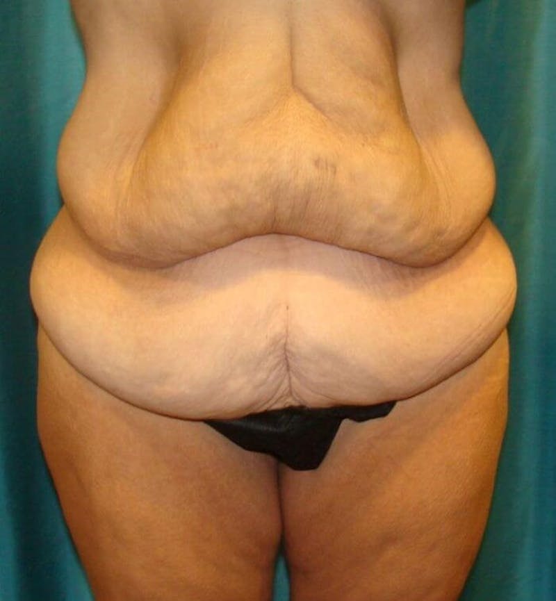 Tummy Tuck Before & After Gallery - Patient 89987992 - Image 3